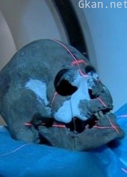 头骨上的洞